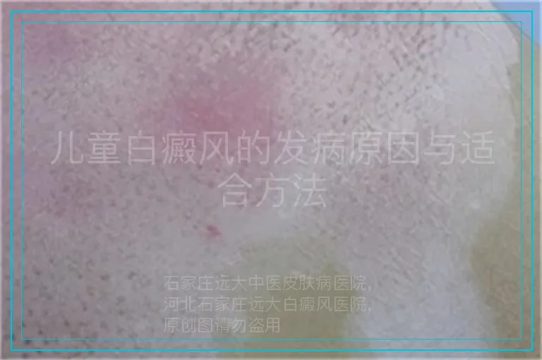 儿童白癜风的发病原因与适合方法