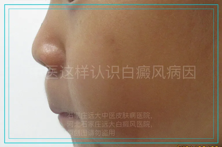 中医这样认识白癜风病因