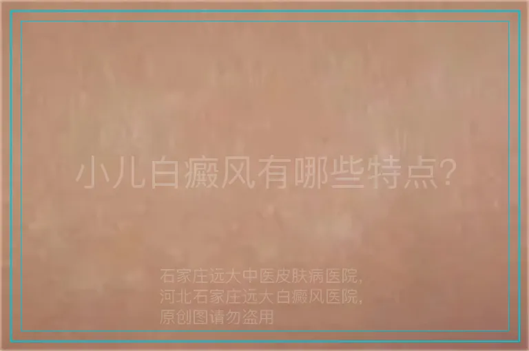 小儿白癜风有哪些特点？