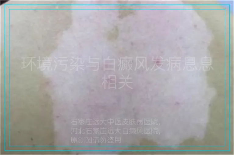 环境污染与白癜风发病息息相关