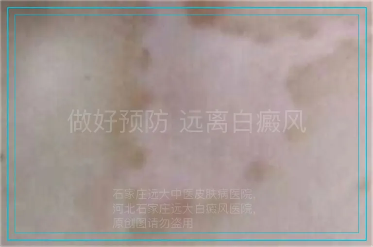 做好预防 远离白癜风