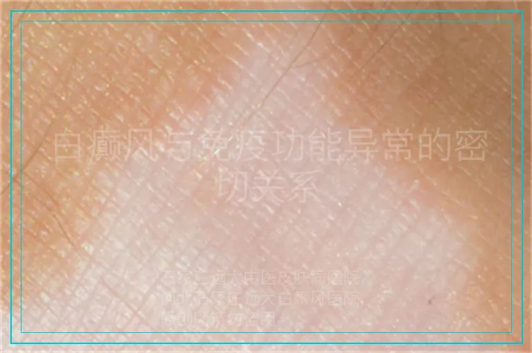 白癫风与免疫功能异常的密切关系