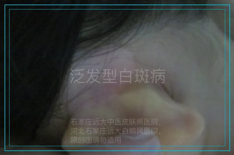 泛发型白斑病