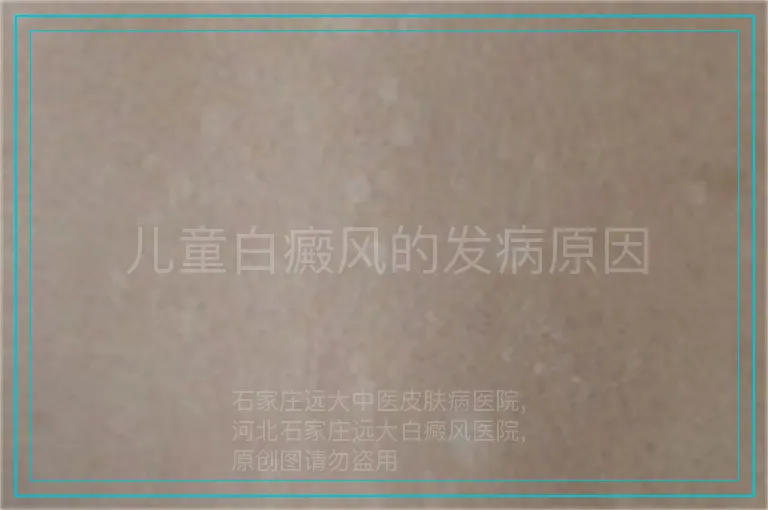 儿童白癜风的发病原因