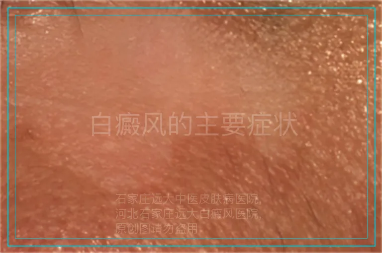白癜风的主要症状