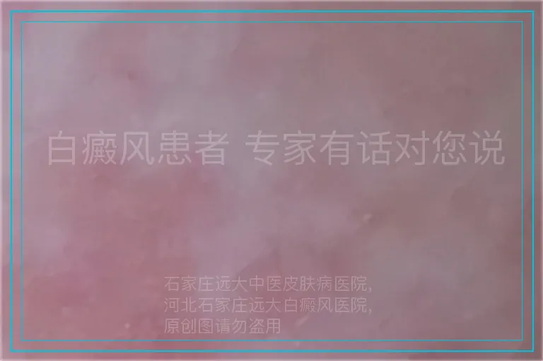白癜风患者 专家有话对您说