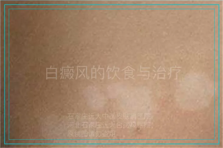 白癜风的饮食与治疗