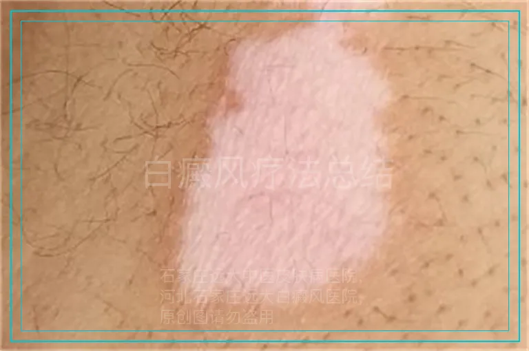 白癜风疗法总结