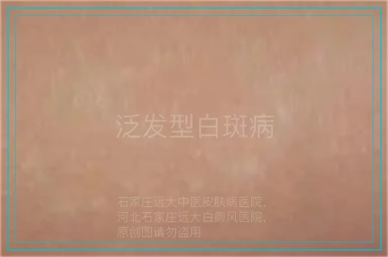 泛发型白斑病