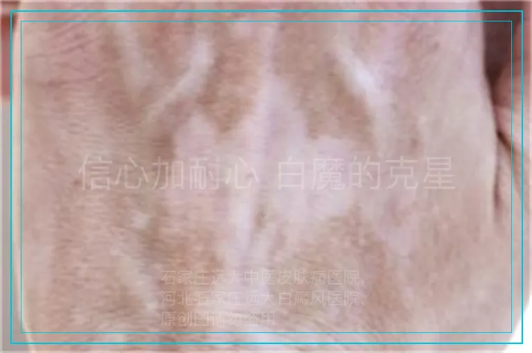 信心加耐心 白魔的克星