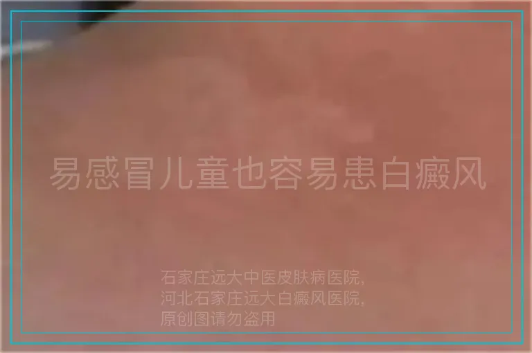 易感冒儿童也容易患白癜风