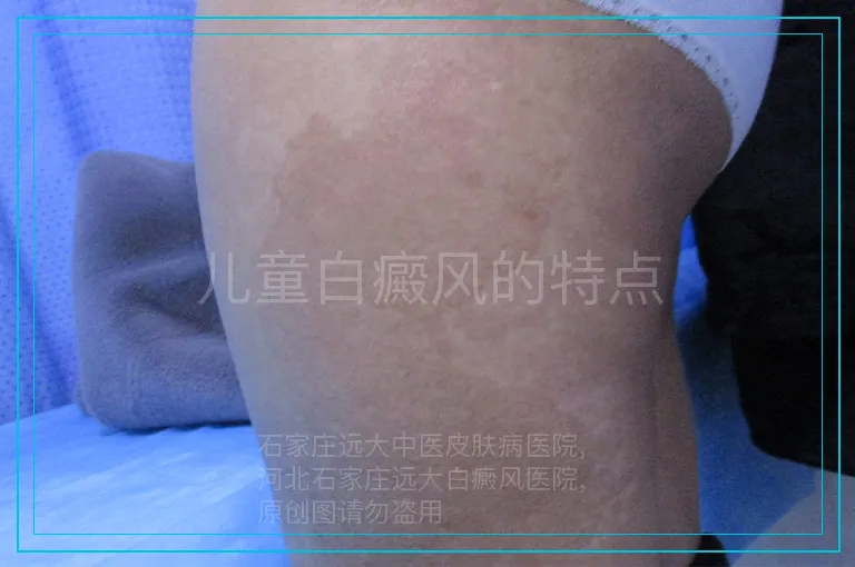 儿童白癜风的特点