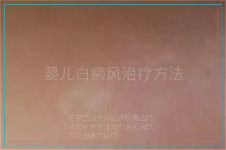 婴儿白癜风治疗方法