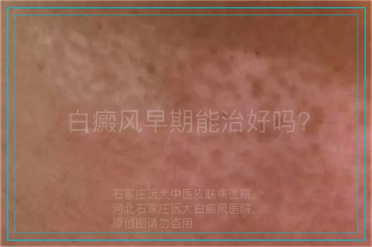 白癜风早期能治好吗?