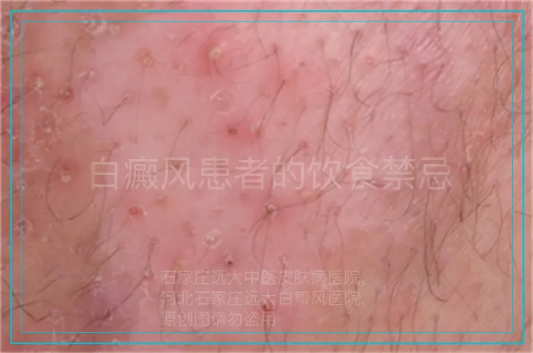 白癜风患者的饮食禁忌