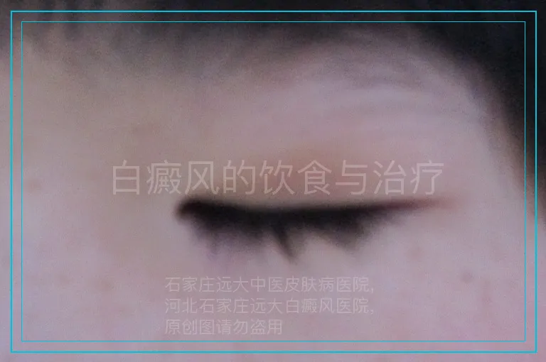 白癜风的饮食与治疗