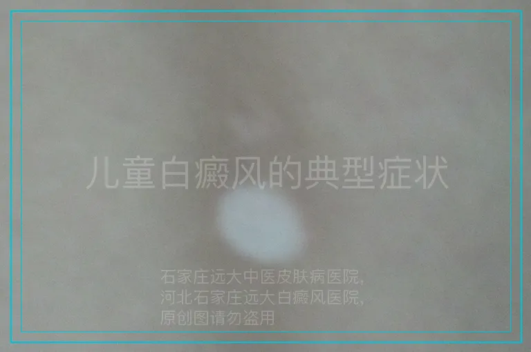 儿童白癜风的典型症状