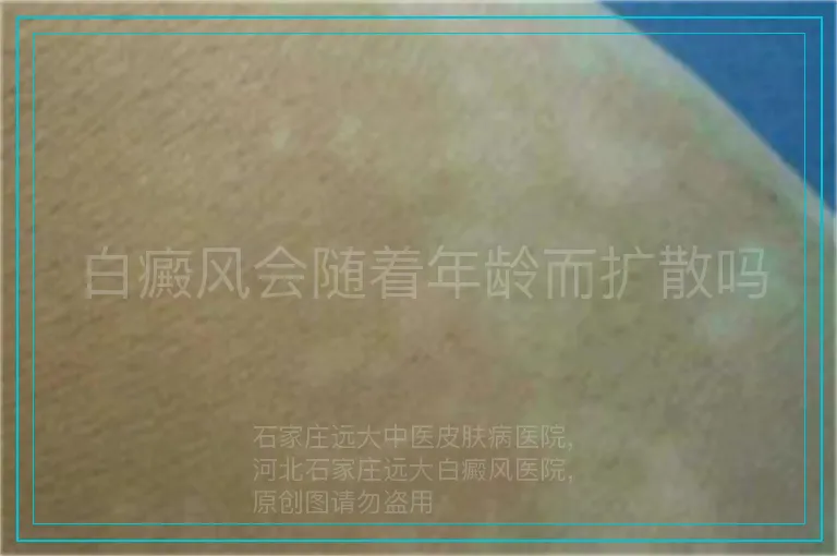 白癜风会随着年龄而扩散吗