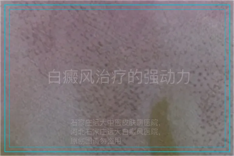 白癜风治疗的强动力