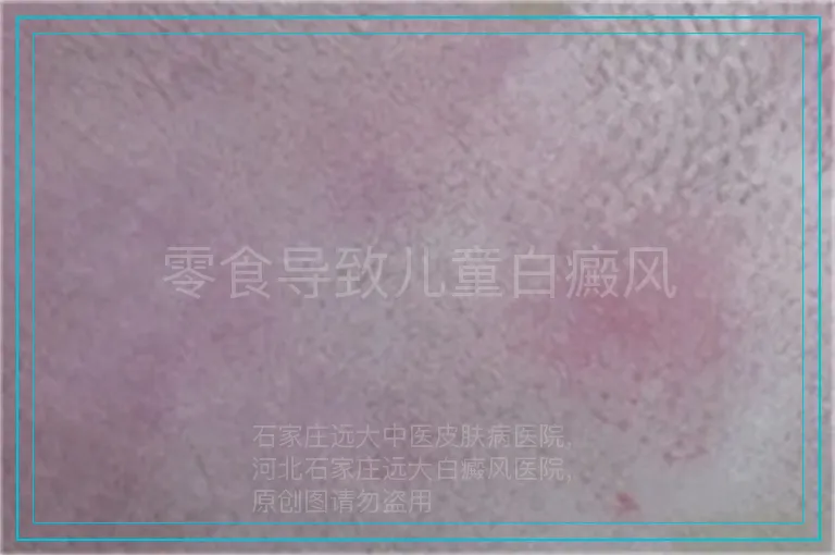 零食导致儿童白癜风