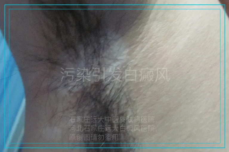 污染引发白癜风