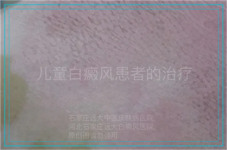 儿童白癜风患者的治疗
