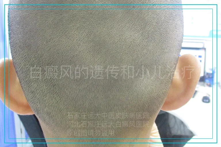 白癜风的遗传和小儿治疗