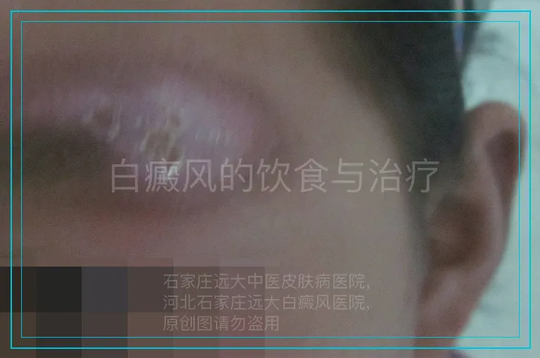 白癜风的饮食与治疗