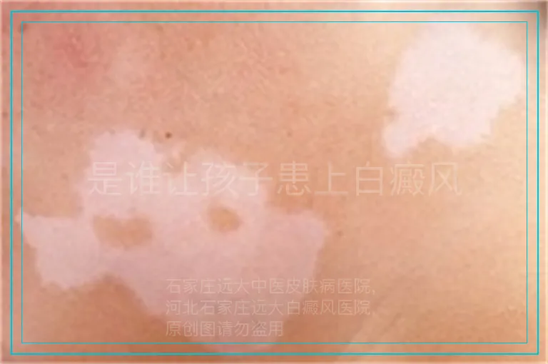 是谁让孩子患上白癜风