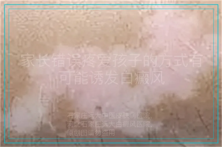 家长错误疼爱孩子的方式有可能诱发白癜风