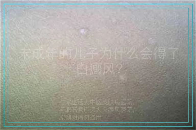 未成年的儿子为什么会得了白癜风？