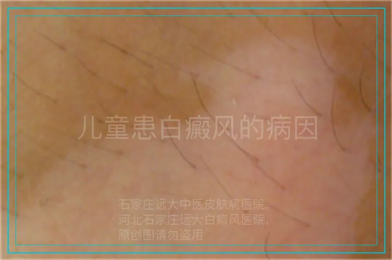 儿童患白癜风的病因