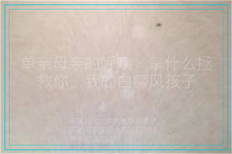 单亲母亲的呼唤：拿什么拯救你，我的白癜风孩子