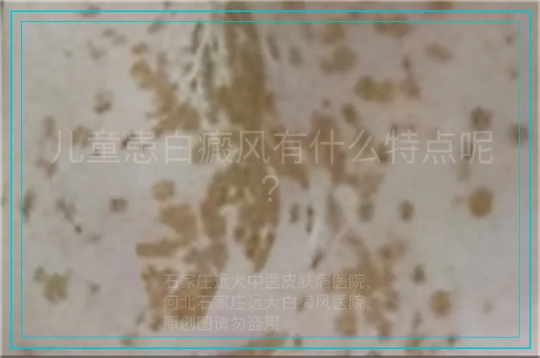 儿童患白癜风有什么特点呢？