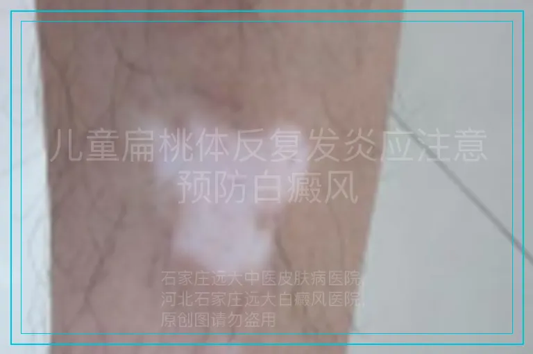 儿童扁桃体反复发炎应注意预防白癜风