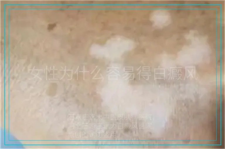 女性为什么容易得白癜风