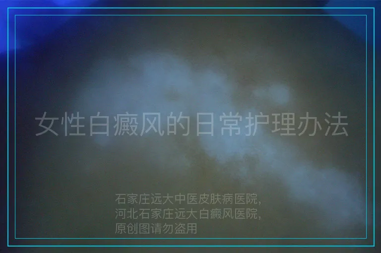 女性白癜风的日常护理办法