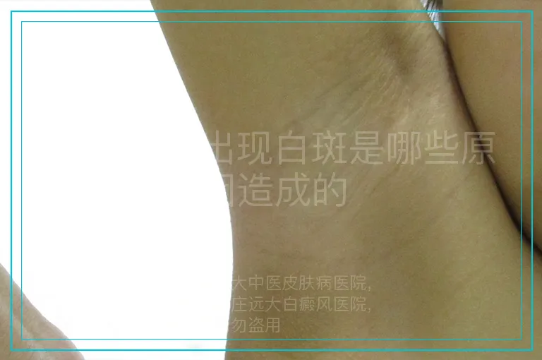 女性面部出现白斑是哪些原因造成的