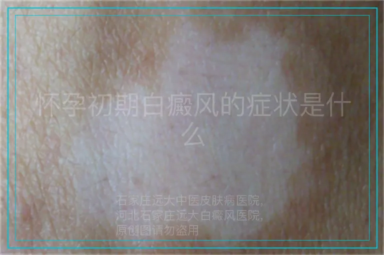 怀孕初期白癜风的症状是什么