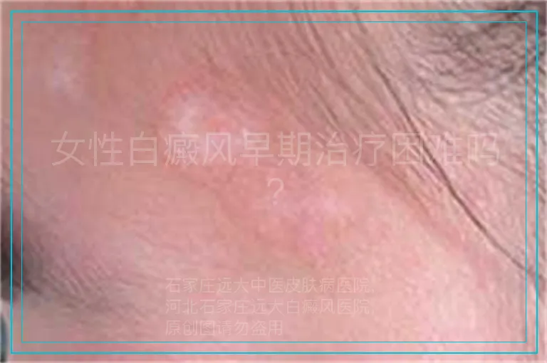 女性白癜风早期治疗困难吗?