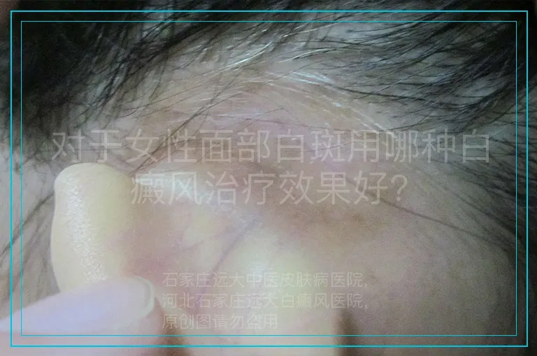 对于女性面部白斑用哪种白癜风治疗效果好?