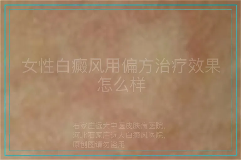 女性白癜风用偏方治疗效果怎么样