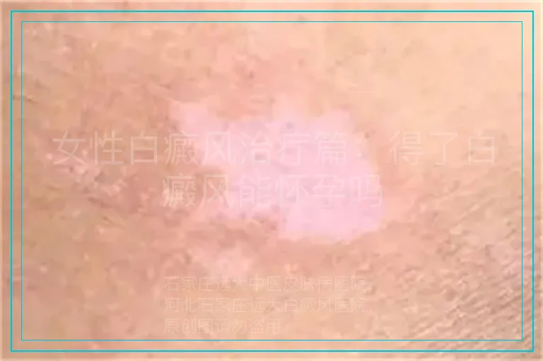 女性白癜风治疗篇：得了白癜风能怀孕吗