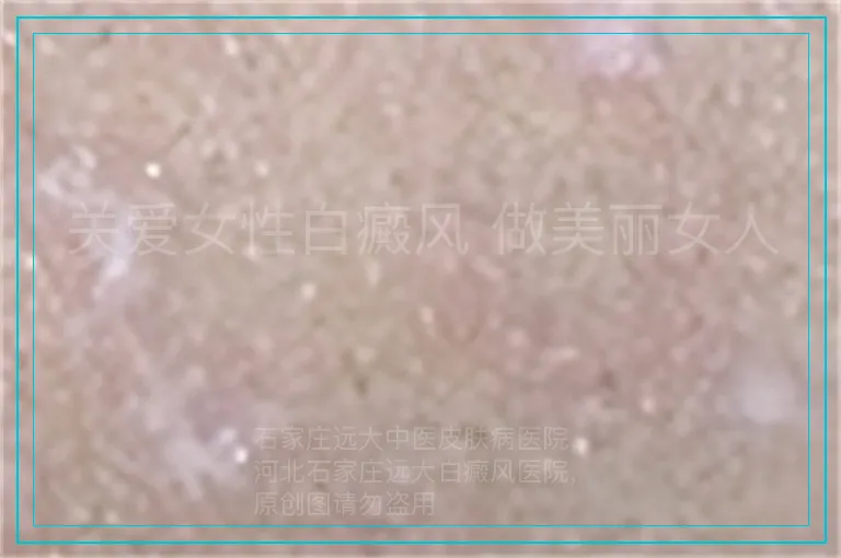 关爱女性白癜风 做美丽女人