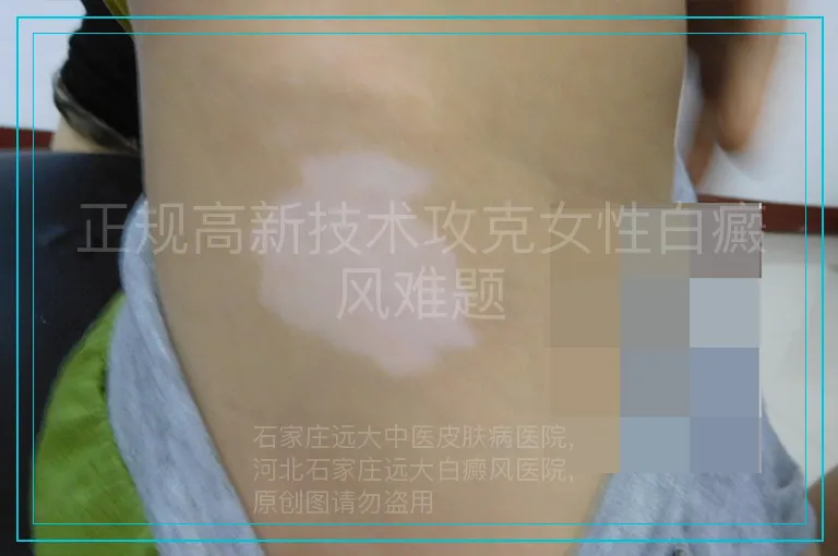 正规高新技术攻克女性白癜风难题