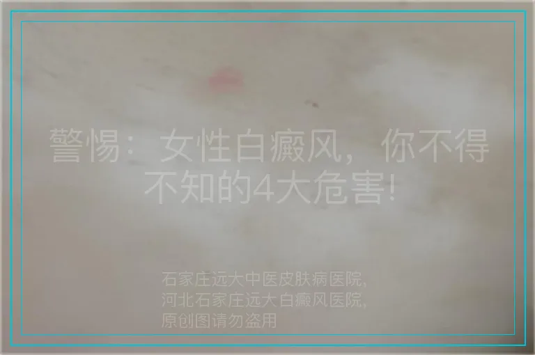 警惕：女性白癜风，你不得不知的4大危害!