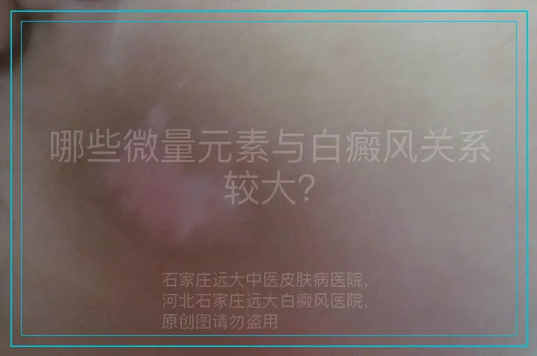 哪些微量元素与白癜风关系较大？