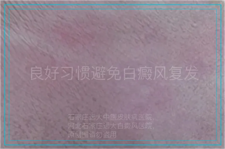 良好习惯避免白癜风复发