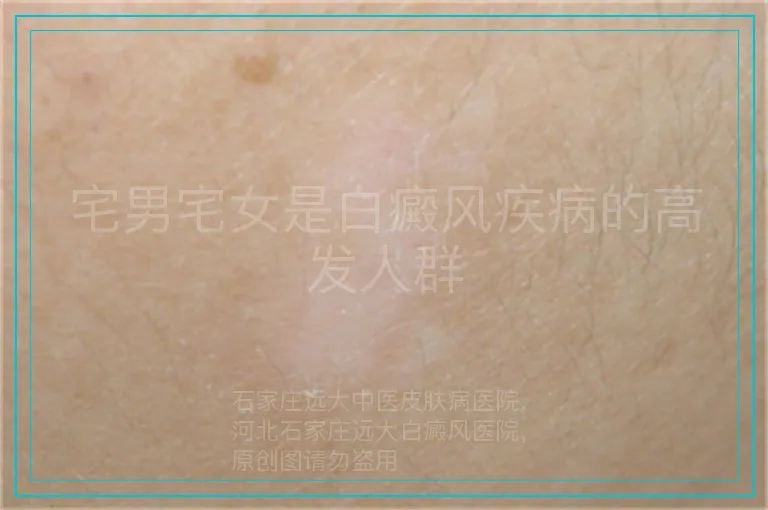 宅男宅女是白癜风疾病的高发人群