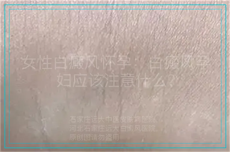 女性白癜风怀孕：白癜风孕妇应该注意什么？